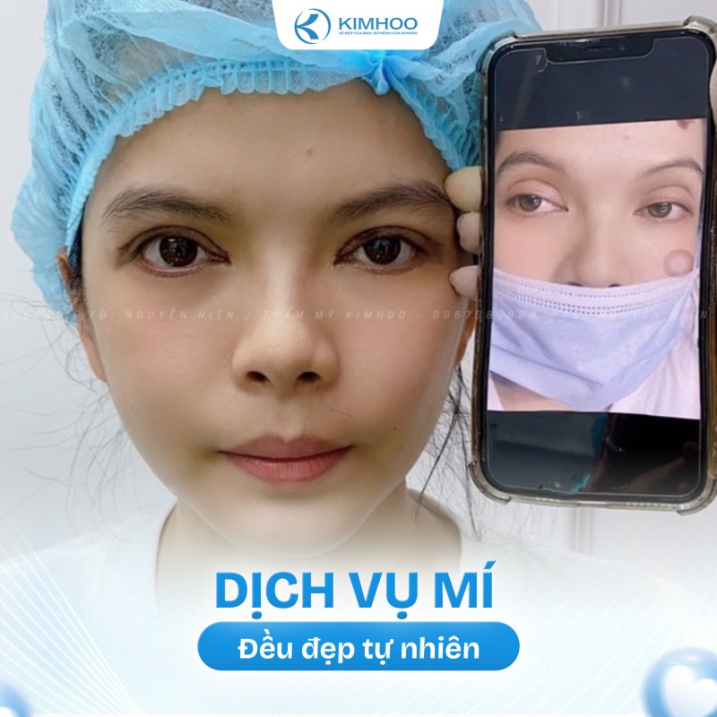 Kết quả 5 – PTTM Mí mắt