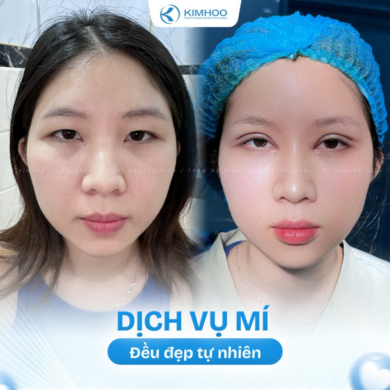 Kết quả 6 – PTTM Mí mắt