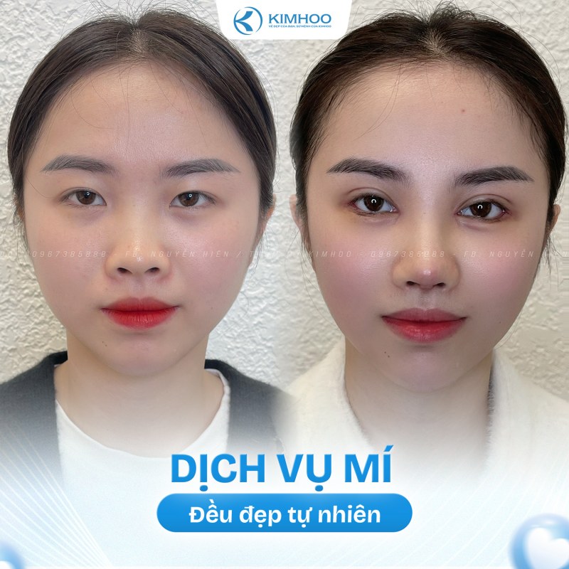 Kết quả 3 – PTTM Mí mắt