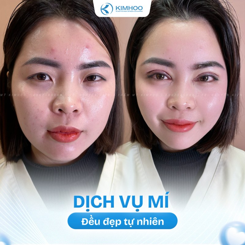 Kết quả 7 – PTTM Mí mắt