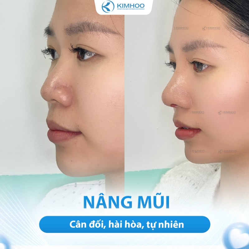 Kết quả 1 – Nâng Mũi