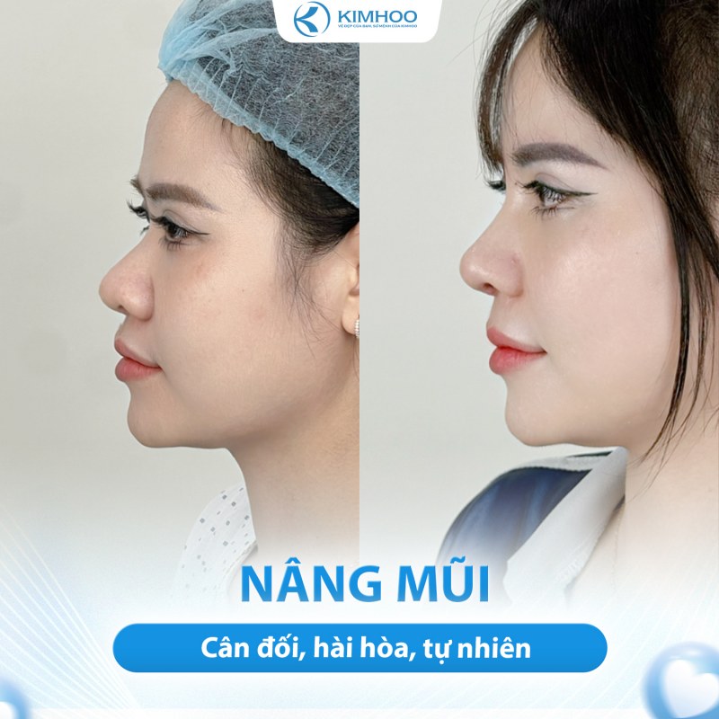 Kết quả 5 – Nâng Mũi