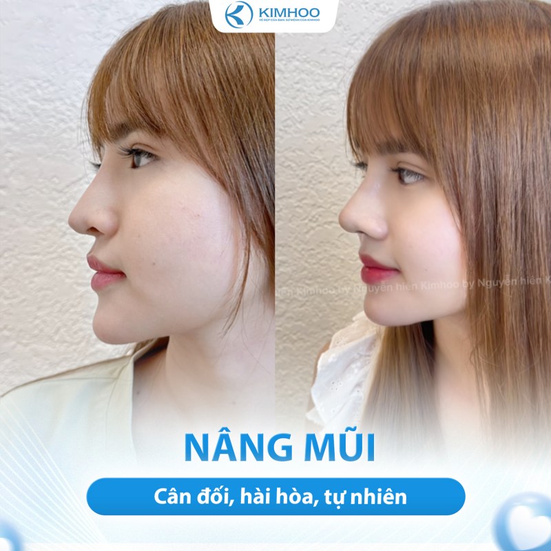 Kết quả 4 – Nâng Mũi
