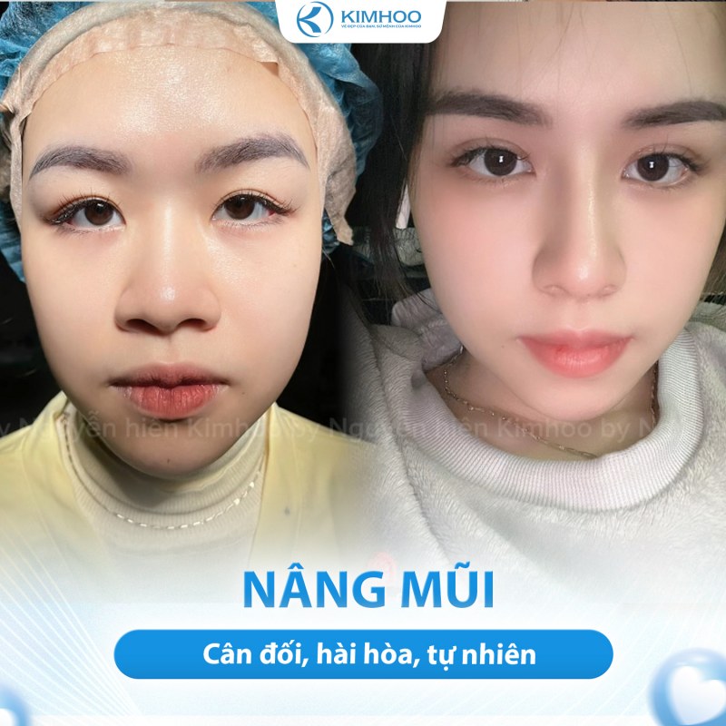 Kết quả 2 – Nâng Mũi