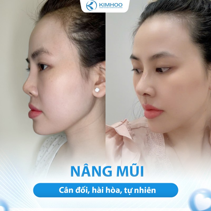 Kết quả 6 – Nâng Mũi