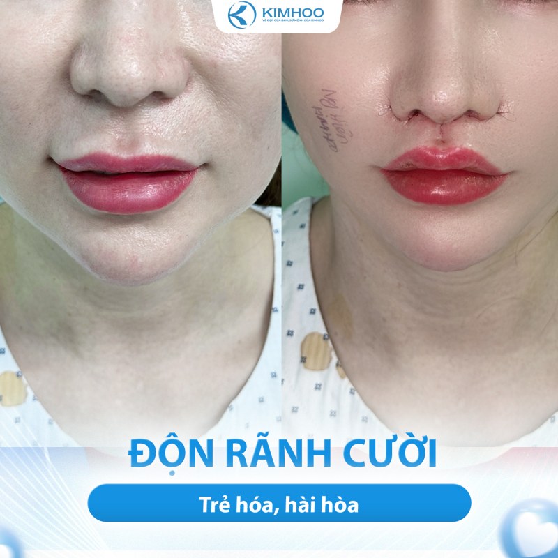 Kết quả 3 – PTTM Hạ Hàm Hô