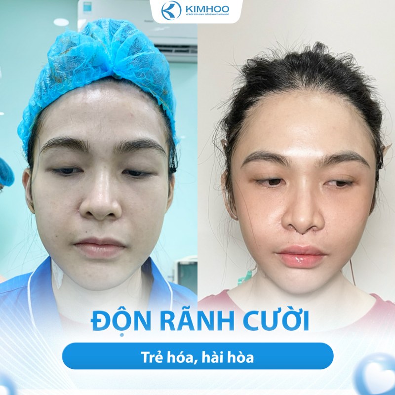 Kết quả 2 – PTTM Hạ Hàm Hô