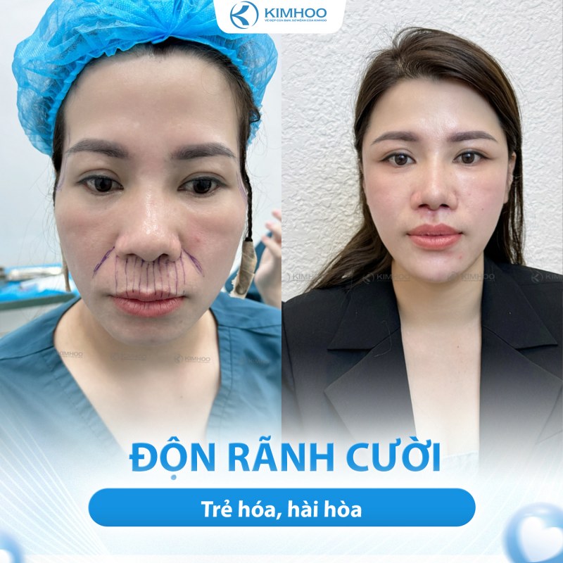 Kết quả 1 – PTTM Hạ Hàm Hô