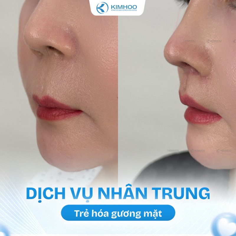 Kết quả 3 – Nhân Trung