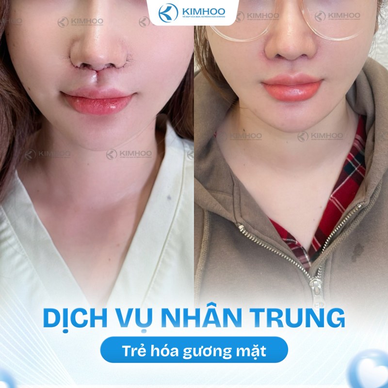 Kết quả 11 – Nhân Trung