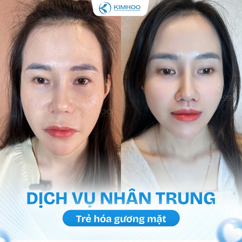 Kết quả 6 – Nhân Trung